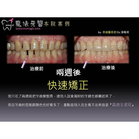 牙齿贴片 - Dental Esthetics-1