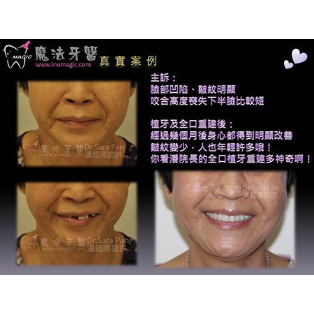 台北市植牙 - Dental Implants-5