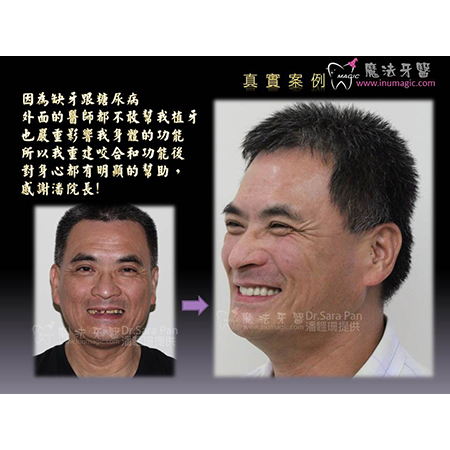 糖尿病植牙 - Dental Implants-19