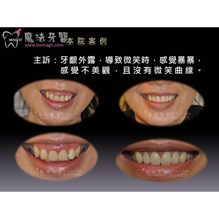 牙龈外露 - Full Mouth Reconstruction-5