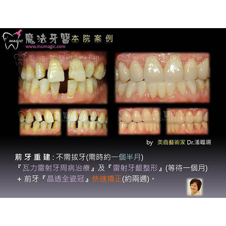 美白贴片 - Dental Esthetics-6