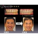 大暴牙 - Full Mouth Reconstruction-4