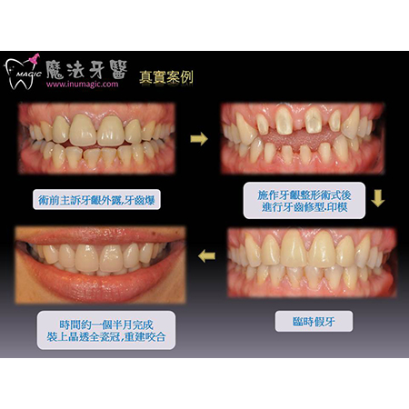 临时假牙 - Dental Prosthodontics-2