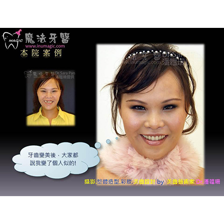 牙齿美白 - Dental Esthetics-9