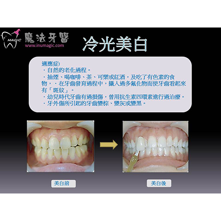 冷光美白 - Dental Esthetics-10