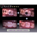 假牙补助 - Dental Prosthodontics-4