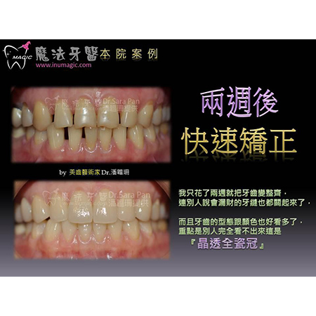 牙齿美白贴片 - Dental Esthetics-7