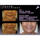 台北市植牙 - Dental Implants-5