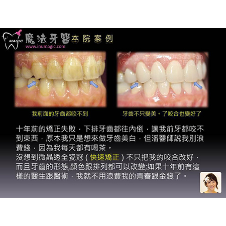 美白牙齿贴片 - Dental Esthetics-12