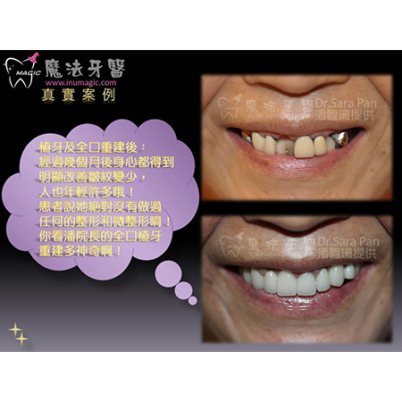 植牙费用 - Dental Implants-11