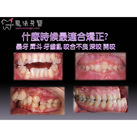 儿童矫正 - Children Dental-3