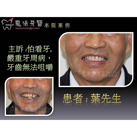 牙龈整形 - Full Mouth Reconstruction-2