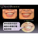 全口假牙 - Dental Prosthodontics-1