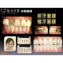 美白牙齿 - Dental Esthetics-11