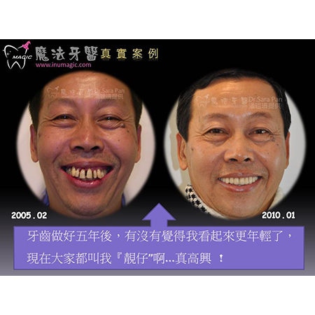 水雷射治疗牙周病 - Dental Laser-1