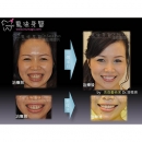 笑露牙龈 - Full Mouth Reconstruction-7