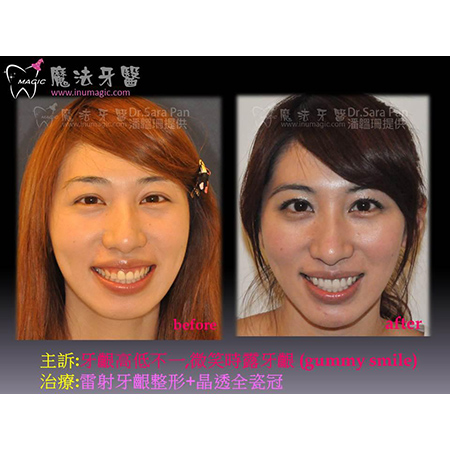 牙龈外露整形 - Full Mouth Reconstruction-3