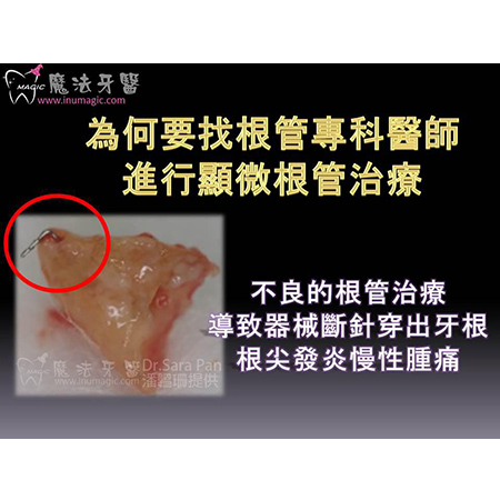 显微镜根管治疗 - Dental Endodontic-6