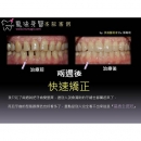 牙齿贴片 - Dental Esthetics-1