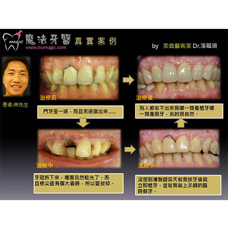 门牙植牙 - Dental Implants-12