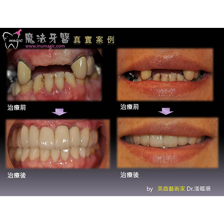牙齿缺牙 - Dental Implants-21