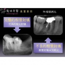 根管钙化 - Dental Endodontic-1