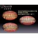 透明矫正器 - Dental Orthodontic-10