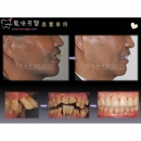 无痛植牙 - Dental Implants-13