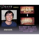 微创植牙 - Dental Laser-5