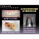 显微根管治疗 - Dental Endodontic-4