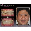 治牙周病 - Periodontal Disease Treatment-6