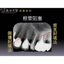 牙医根管治疗 - Dental Endodontic-2