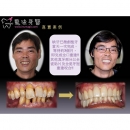 牙周治疗 - Dental Laser-2