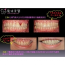 牙龈发炎 - Periodontal Disease Treatment-2