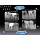 显微根管 - Dental Endodontic-3