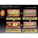 门牙植牙 - Dental Implants-12