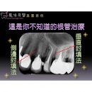 抽神经 - Dental Endodontic-5