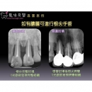 根尖手术 - Dental Endodontic-7