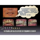 植牙过程 - Dental Implants-1