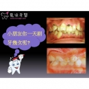 咬合不正 - Children Dental-2
