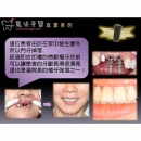 即拔即种 - Dental Implants-18