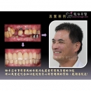 植牙诊所 - Dental Implants-4
