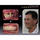 缺牙后遗症 - Good Dentist-14