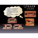 牙周病症状 - Periodontal Disease Treatment-4