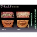 水雷射植牙 - Dental Laser-6