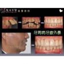 种牙 - Dental Implants-9