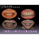 牙齿矫正器 - Dental Orthodontic-2