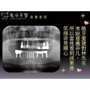 全口植牙 - Dental Implants-14