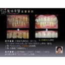 植牙好处 - Dental Implants-17