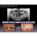 人工植牙过程 - Dental Implants-8